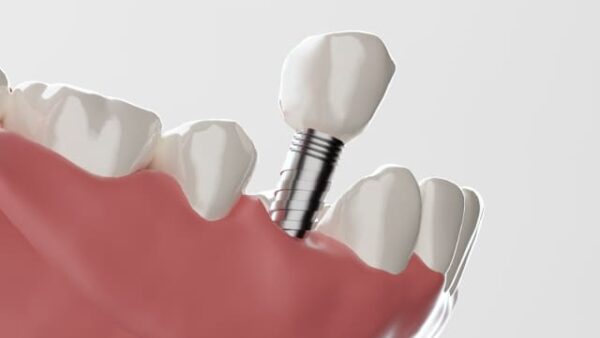 インプラント